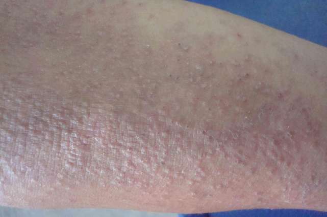 怀孕身上起红疙瘩是湿疹吗 怀孕身上起红疙瘩是湿疹吗