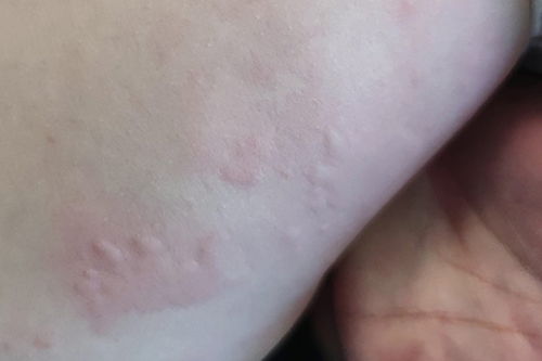 嗓子发干发痒有痰咳嗽怎么办 嗓子发干发痒有痰咳嗽怎么办