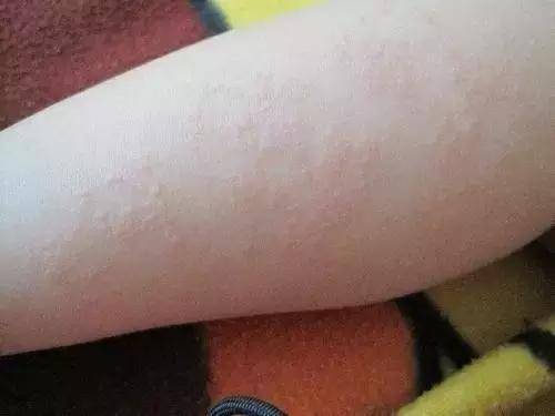 皮下脂肪瘤有哪些临床表现 皮下脂肪瘤有哪些临床表现