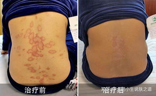过敏荨麻疹怎么缓解 过敏荨麻疹怎么缓解