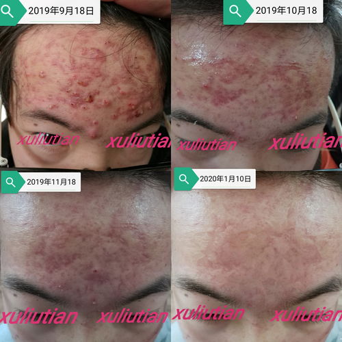 灰指甲发病会出现什么症状特征 灰指甲发病会出现什么症状特征