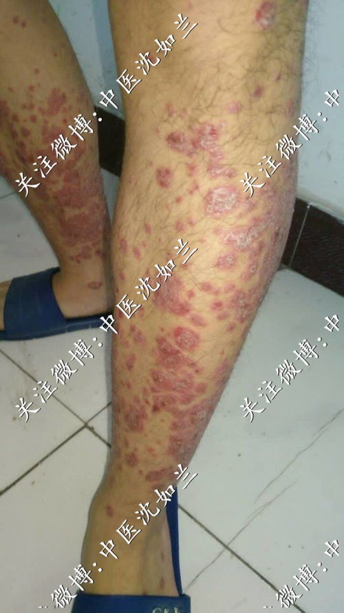 孕妇患有荨麻疹怎么治疗 孕妇患有荨麻疹怎么治疗