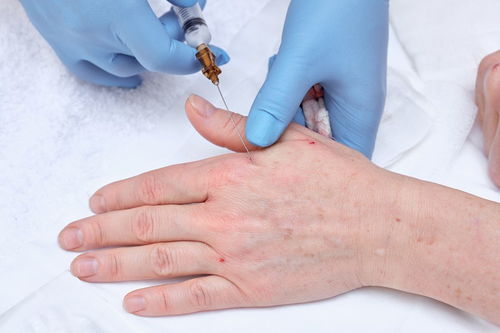 鉴别灰指甲与指甲营养障碍 症状与诊断方法 鉴别灰指甲与指甲营养障碍 症状与诊断方法