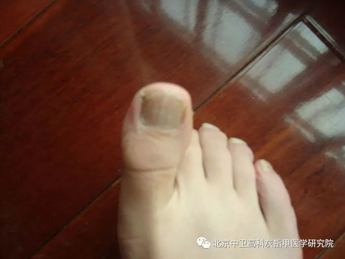 牛皮癣不治疗会有什么危害 牛皮癣不治疗会有什么危害