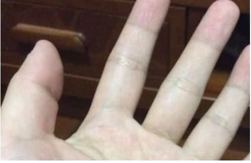 治疗脚气常见的办法是什么 治疗脚气常见的办法是什么