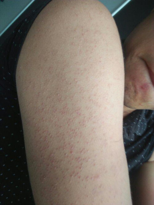 2岁宝宝长脚气怎么办 2岁宝宝长脚气怎么办