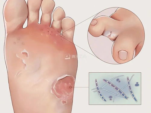 灰指甲需要哪些护理工作才能容易好 灰指甲需要哪些护理工作才能容易好