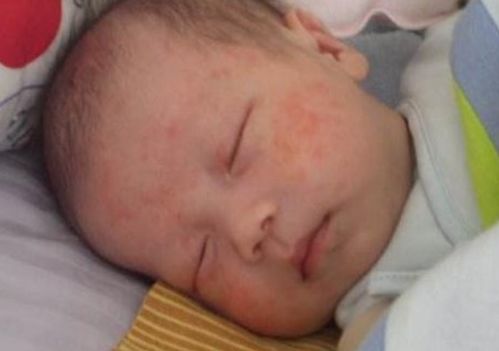 2025年皮肤健康新知 痤疮与皮炎关联深度 2025年皮肤健康新知 痤疮与皮炎关联深度