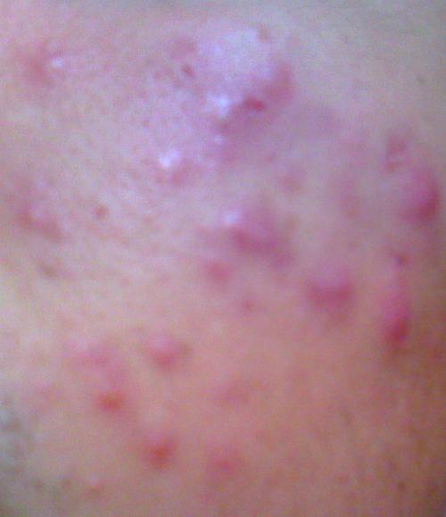 怎样根治人乳头瘤病毒 怎样根治人乳头瘤病毒