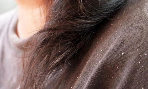 浅析几种有效的预防灰指甲的方法 浅析几种有效的预防灰指甲的方法