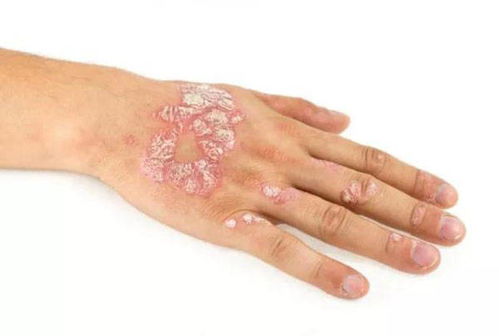 急性湿疹最开始的症状有哪些 急性湿疹最开始的症状有哪些