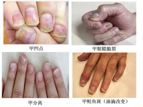 灰指甲不治疗会怎样 灰指甲不治疗会怎样