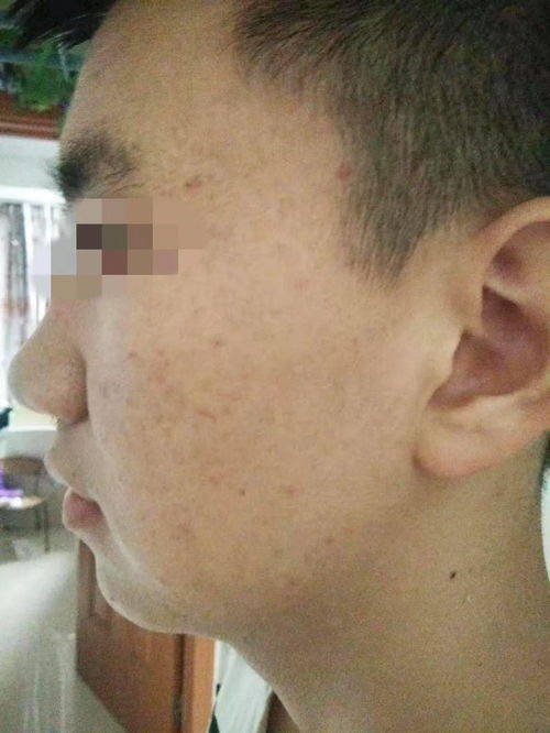 北京有名皮肤病医院 痤疮反复发作的原因是什么 北京有名皮肤病医院 痤疮反复发作的原因是什么