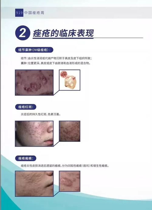 中医如何认识脚气 中医如何认识脚气