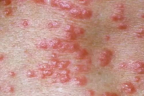 治脚气有什么好方法 生姜水去脚气 治脚气有什么好方法 生姜水去脚气