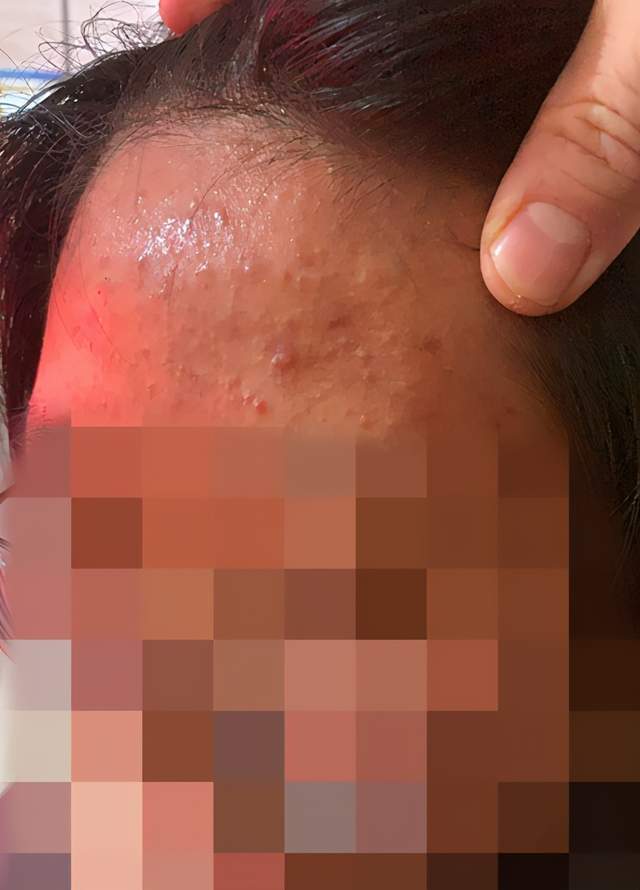 一个多月宝宝脸上湿疹怎么办 一个多月宝宝脸上湿疹怎么办