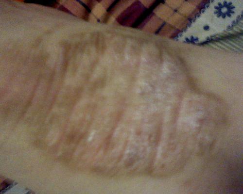 荨麻疹患者饮食方面应该注意什么 荨麻疹患者饮食方面应该注意什么