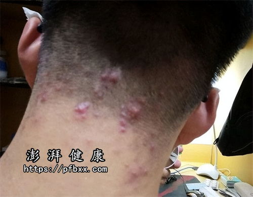 鼻子痒打喷嚏流鼻血怎么治疗 鼻子痒打喷嚏流鼻血怎么治疗