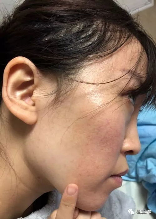 ����ţƤѢ��ʲô֢״