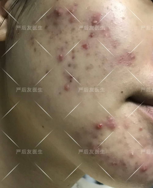 泥沙胆结石症状 泥沙胆结石症状