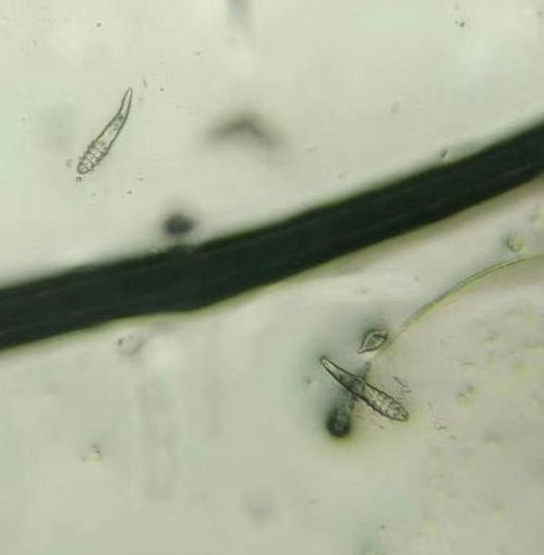 孕晚期湿疹该怎么治疗 孕晚期湿疹该怎么治疗