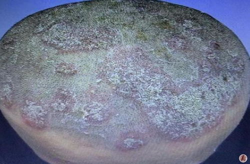 孕妇有荨麻疹如何治疗 孕妇有荨麻疹如何治疗