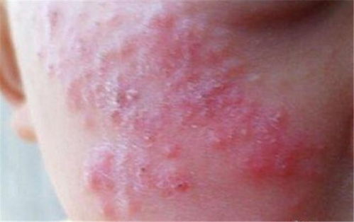 暂时性的痤疮疤痕有哪些类型 暂时性的痤疮疤痕有哪些类型