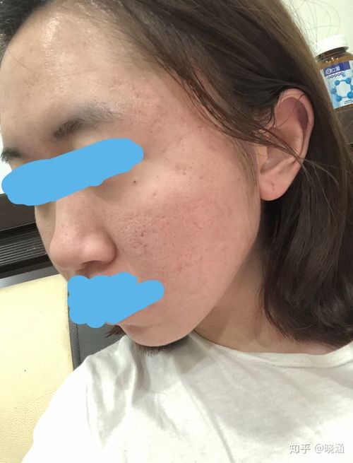 嘴巴上面长水泡 嘴巴上面长水泡