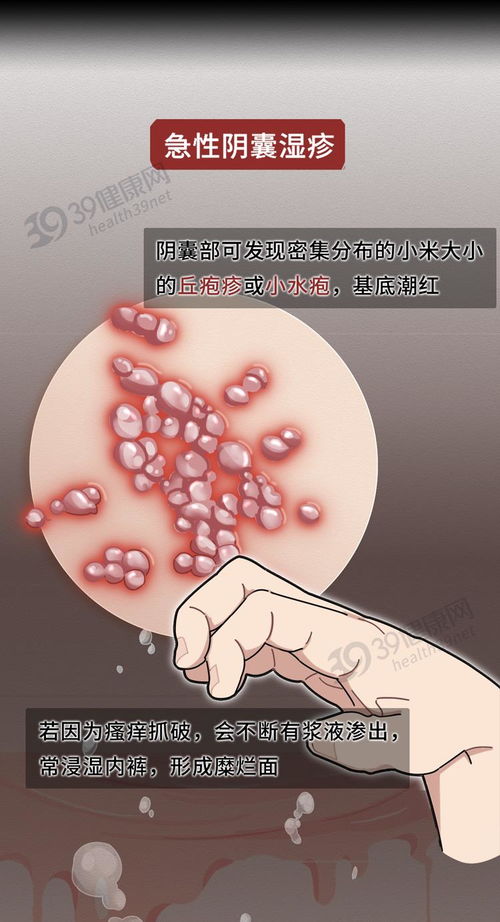 慢性荨麻疹的治疗方法(慢性荨麻疹要怎么治疗 慢性荨麻疹的治疗方法(慢性荨麻疹要怎么治疗