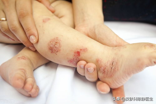 乳腺有结节怎么办还疼 乳腺有结节怎么办还疼