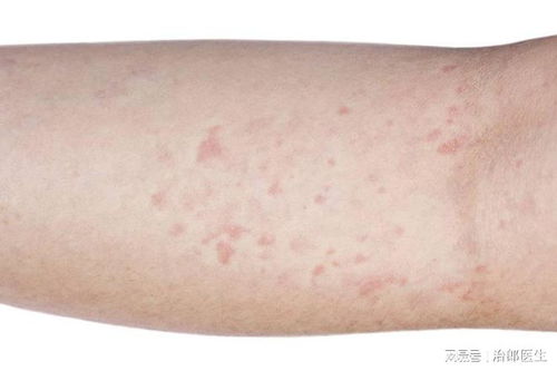 郑州治牛皮癣哪家好紧急牛皮癣的病理生理 郑州治牛皮癣哪家好紧急牛皮癣的病理生理