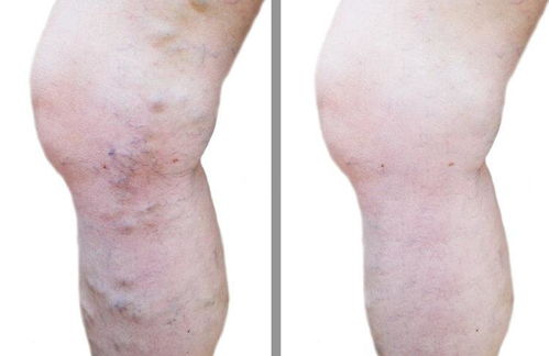 灰指甲反复的原因 灰指甲反复的原因