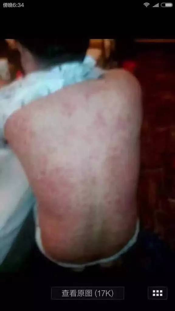 灰指甲具体危害有什么 灰指甲具体危害有什么