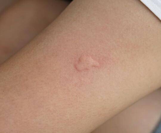 免疫力紊乱好了慢性荨麻疹就会好吗 免疫力紊乱好了慢性荨麻疹就会好吗