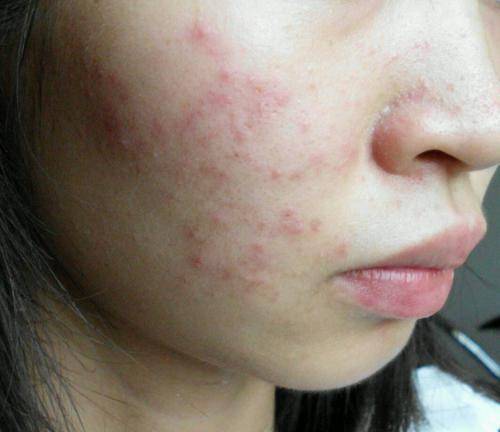 得了灰指甲怎么办 得了灰指甲怎么办