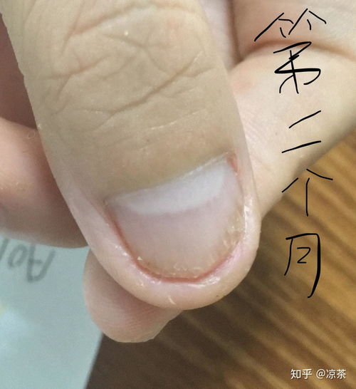 丘性荨麻疹用什么药膏 丘性荨麻疹用什么药膏