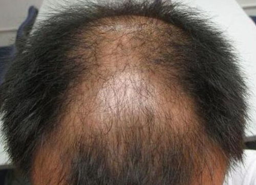 脚气日常注意事项有哪些 脚气日常注意事项有哪些