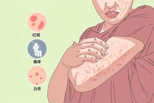 什么原因引起荨麻疹风团 什么原因引起荨麻疹风团