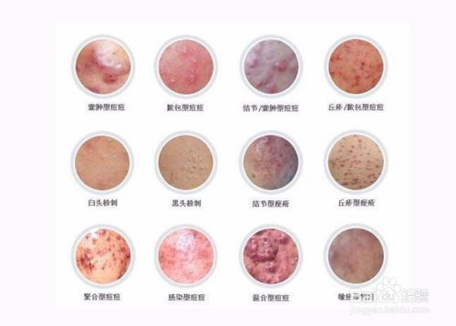 女性右下腹特别的疼是什么原因 女性右下腹特别的疼是什么原因