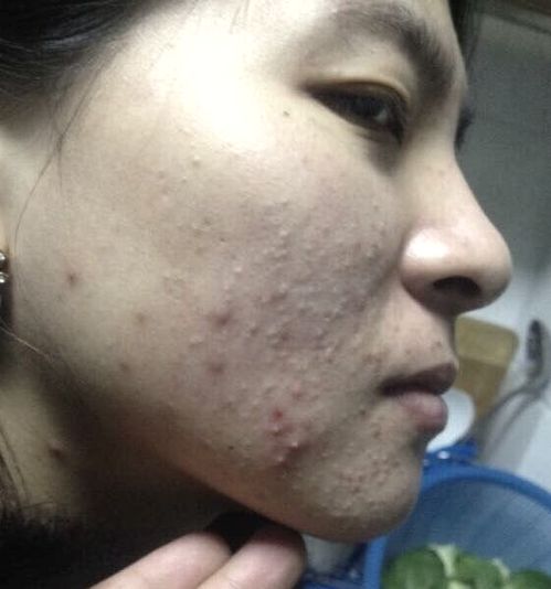 邯郸哪里能痤疮脂溢性皮炎和玫瑰痤疮 邯郸哪里能痤疮脂溢性皮炎和玫瑰痤疮