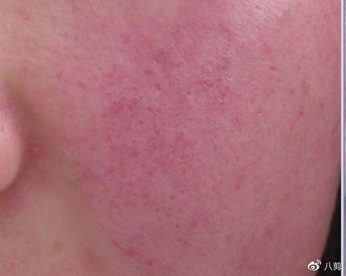 美尼尔氏症是什么病 美尼尔氏症是什么病