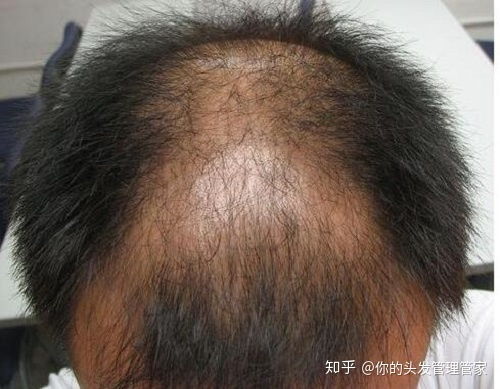 脚气的诱因有什么 脚气的诱因有什么