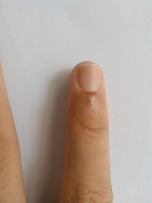 预防痤疮的好办法有什么 预防痤疮的好办法有什么