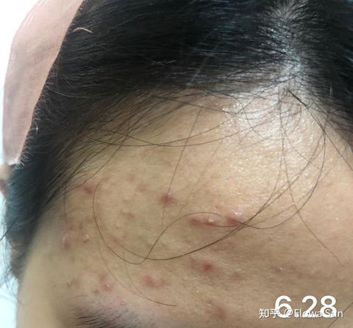 阴茎炎的症状是怎么样 阴茎炎的症状是怎么样