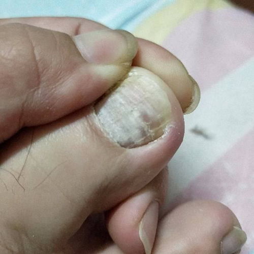 女性痤疮为什么在大姨妈来临加重 女性痤疮为什么在大姨妈来临加重