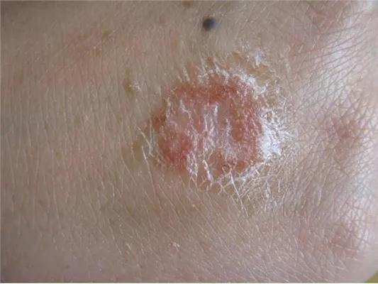 石家庄牛皮癣那个好 石家庄牛皮癣哪家更好 石家庄牛皮癣那个好 石家庄牛皮癣哪家更好