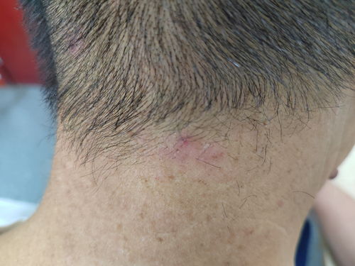 怎样护理痤疮才好 怎样护理痤疮才好