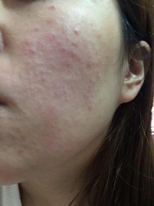 病毒引起的跖疣怎么引起的 病毒引起的跖疣怎么引起的