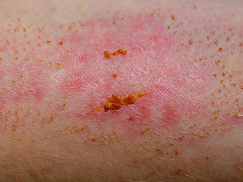 肾结石能不能吃土豆 肾结石能不能吃土豆