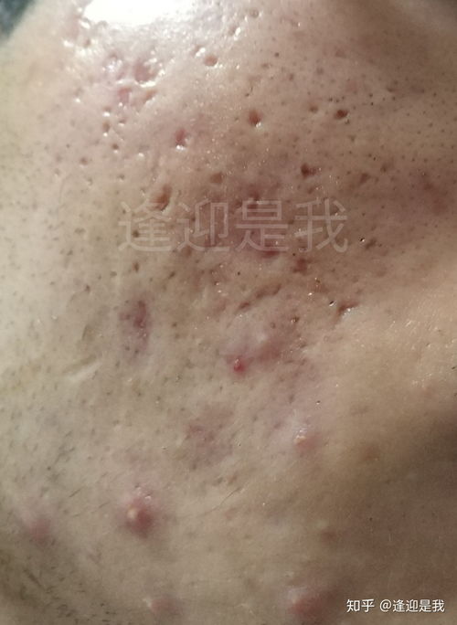 男生预防痤疮疾病的办法有哪些? 男生预防痤疮疾病的办法有哪些?